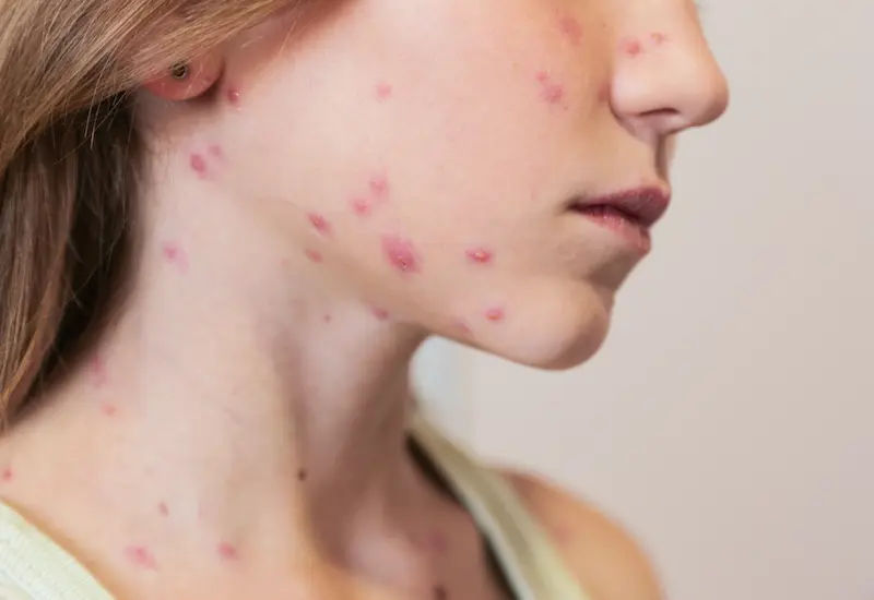 Chickenpox Recognising the Signs and Effective Prevention Strategies